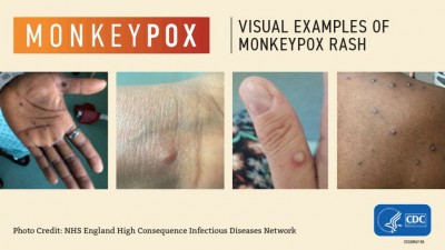 Monkeypox: Educate your Farm Employees